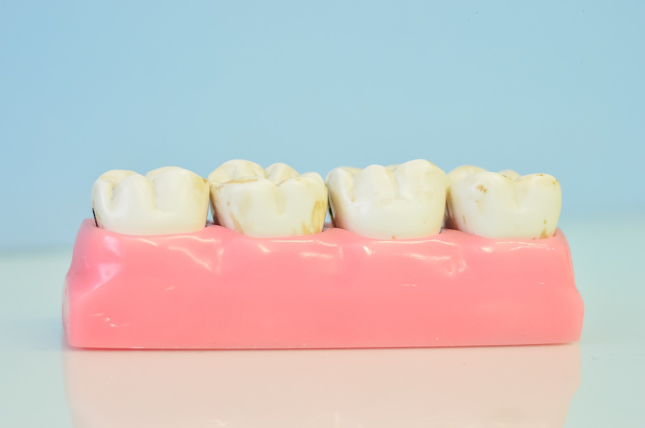 ¿Qué es un puente dental? ¡Te lo explicamos!