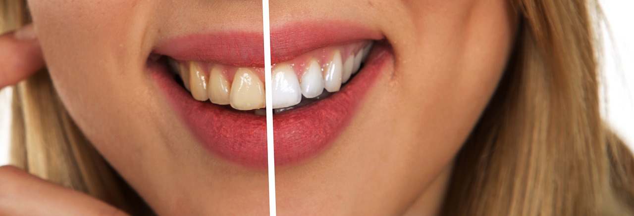 Dudas frecuentes sobre blanqueamiento dental láser