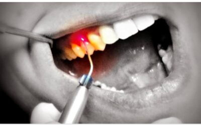 El láser en odontología para conseguir tratamientos mínimamente invasivos
